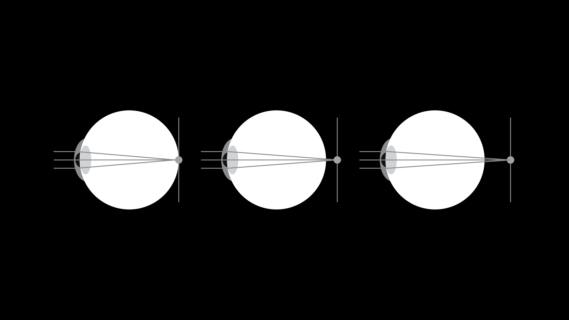 Presbyopia vs myopia vs hyperopia: what’s the difference?